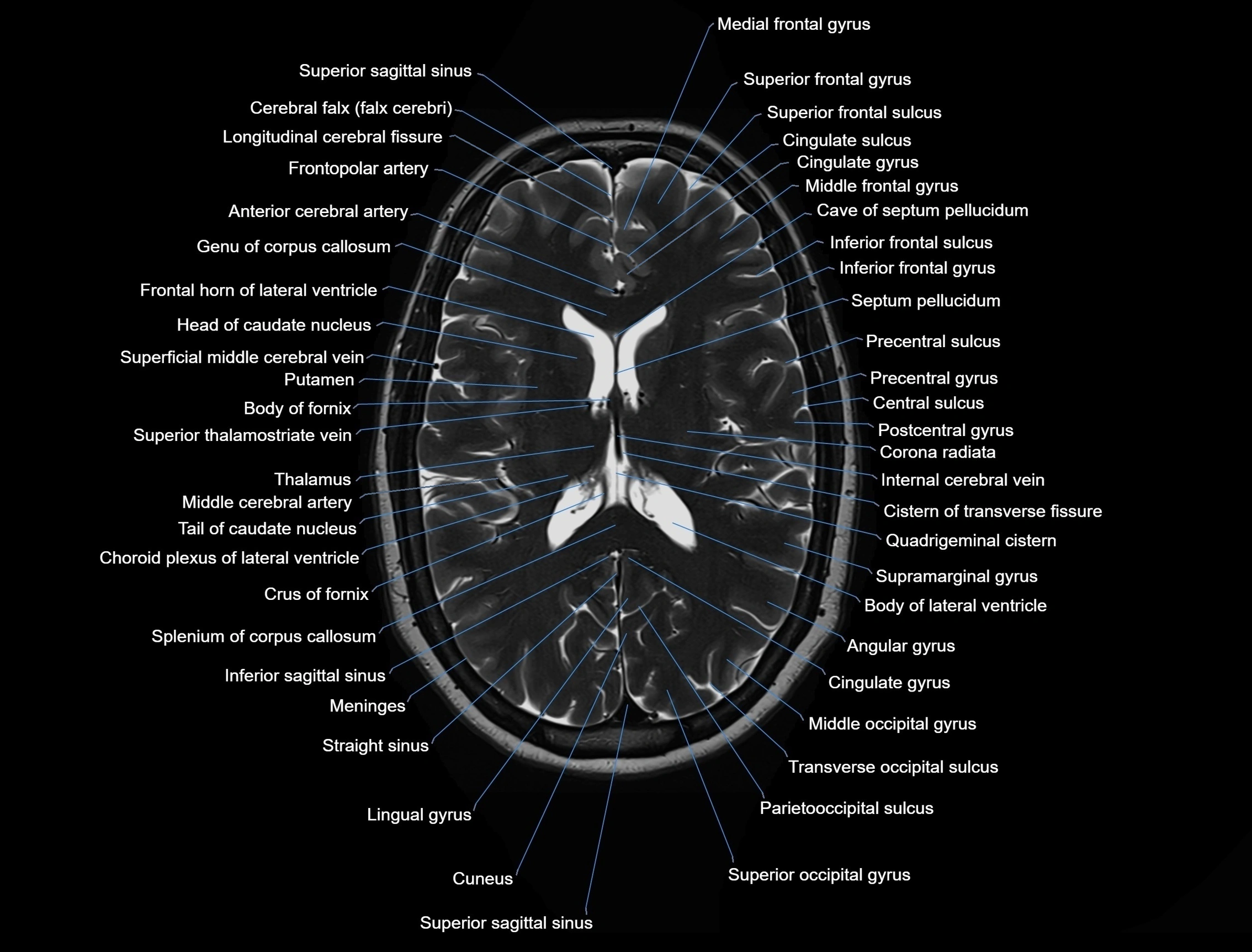MRI Brain axial cross sectional radiology anatomy 3T image  -img-00001-00033.webp